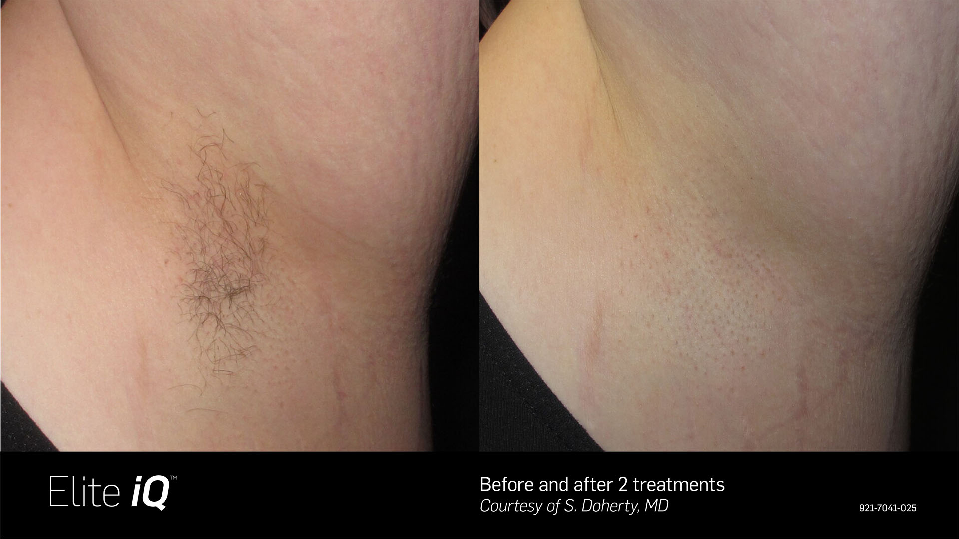 Elite iQ™- Laser Hair Removal