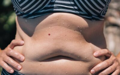 Uneven Weight Gain After Liposuction Why Fat Comes Back in Uneven Spots After Liposuction (and What the Science Actually Says)