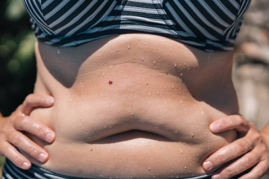 Uneven Weight Gain After Liposuction Uneven Weight Gain After Liposuction