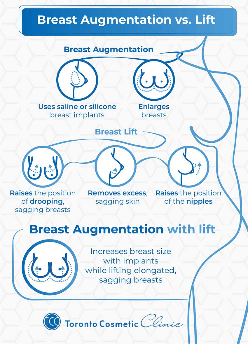breast augmentation vs breast lift infographic toronto Breast Augmentation and Breast Lift procedures at Toronto Cosmetic Clinic