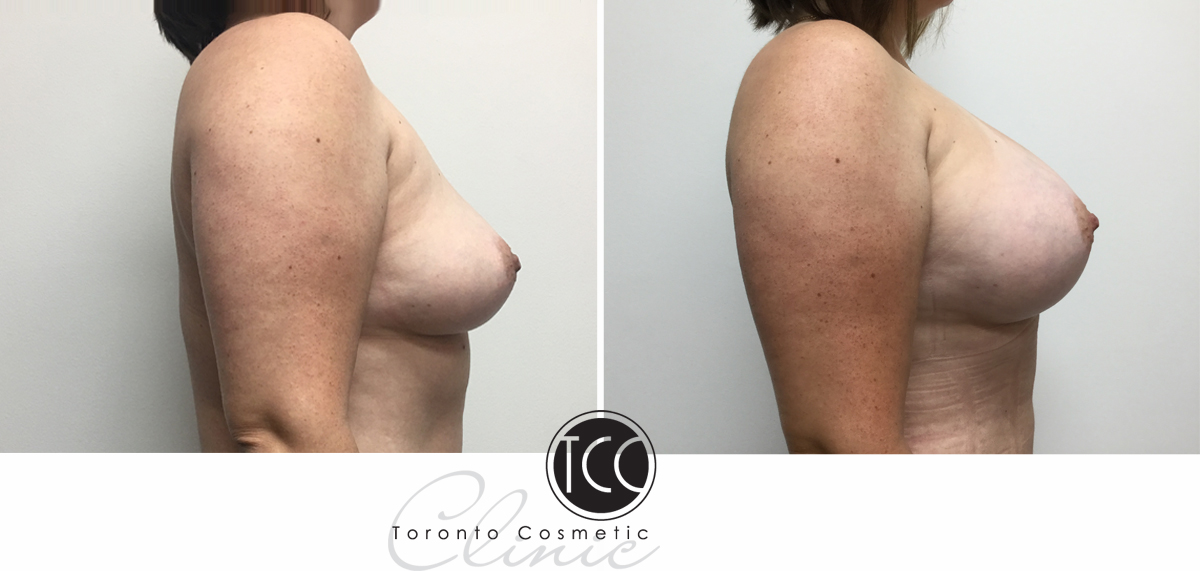 Breast Augmentation Before and After Photo