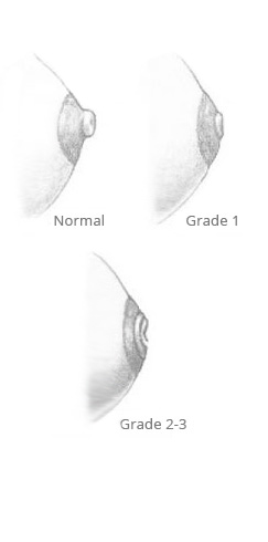 Inverted Nipple Grades