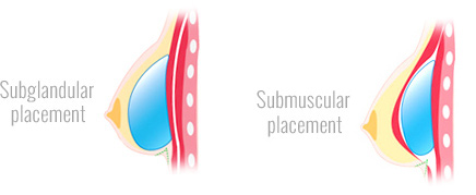 Subglandular and Submuscular Breast Implant Placement