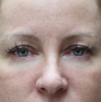 Fat Transfer to the Face - After Fat Transfer to the Face - After