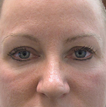 Fat Transfer to the Face - Before Fat Transfer to the Face - Before