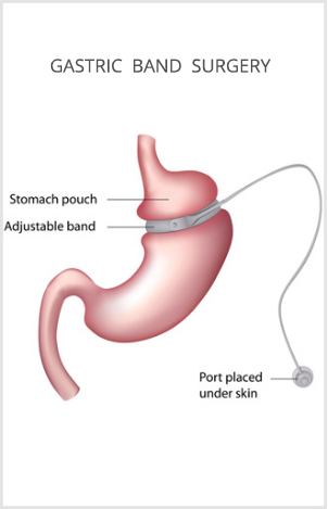 What are the Benefits of Gastric Sleeve Surgery? - Lap Banding What are the Benefits of Gastric Sleeve Surgery? - Lap Banding