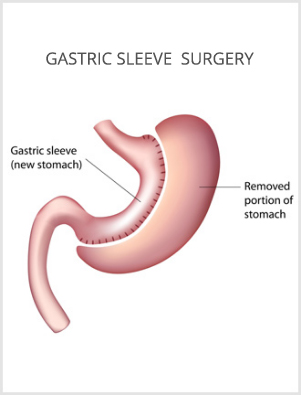 What are the Benefits of Gastric Sleeve Surgery? What are the Benefits of Gastric Sleeve Surgery?